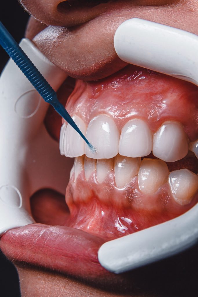 Composite Bonding